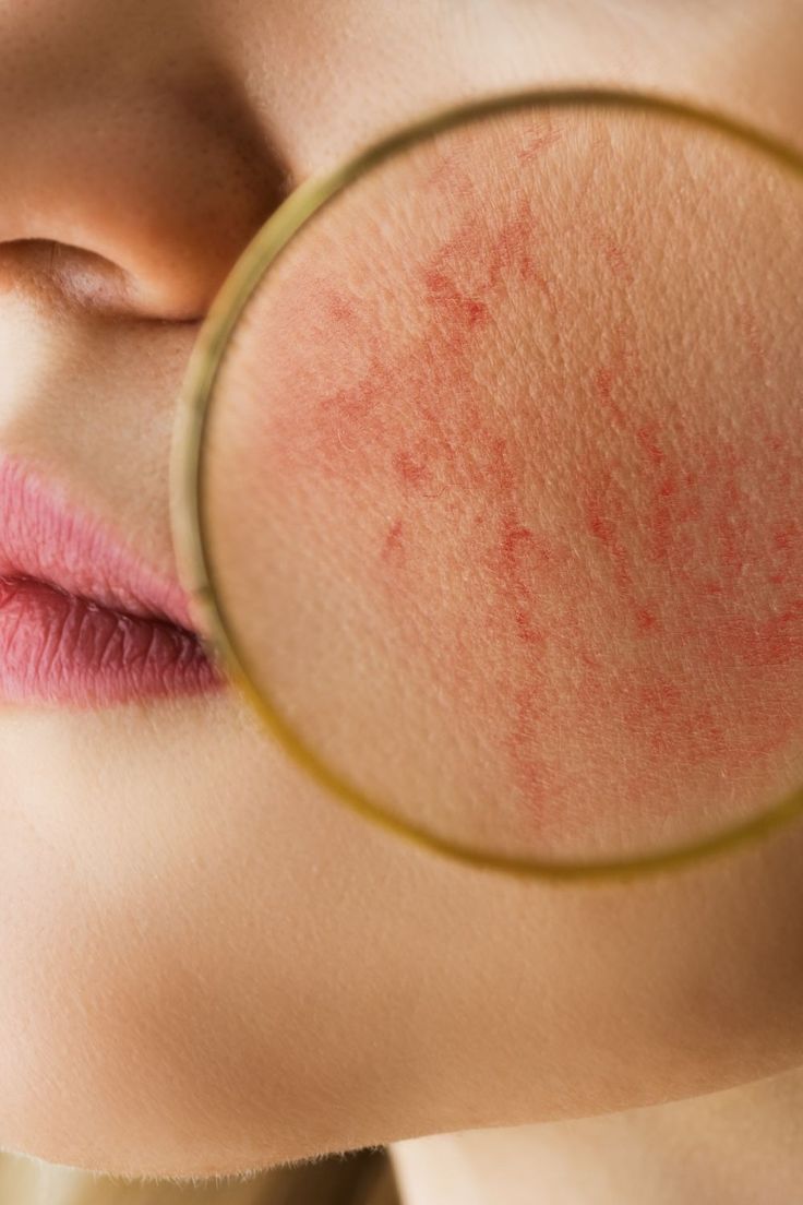 Sensitive Skin