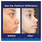 PanOxyl Acne Foaming Wash 10% Benzoyl Peroxide Maximum Strength