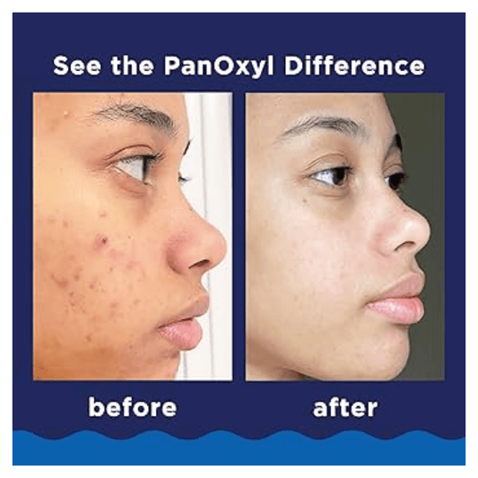 PanOxyl Acne Foaming Wash 10% Benzoyl Peroxide Maximum Strength