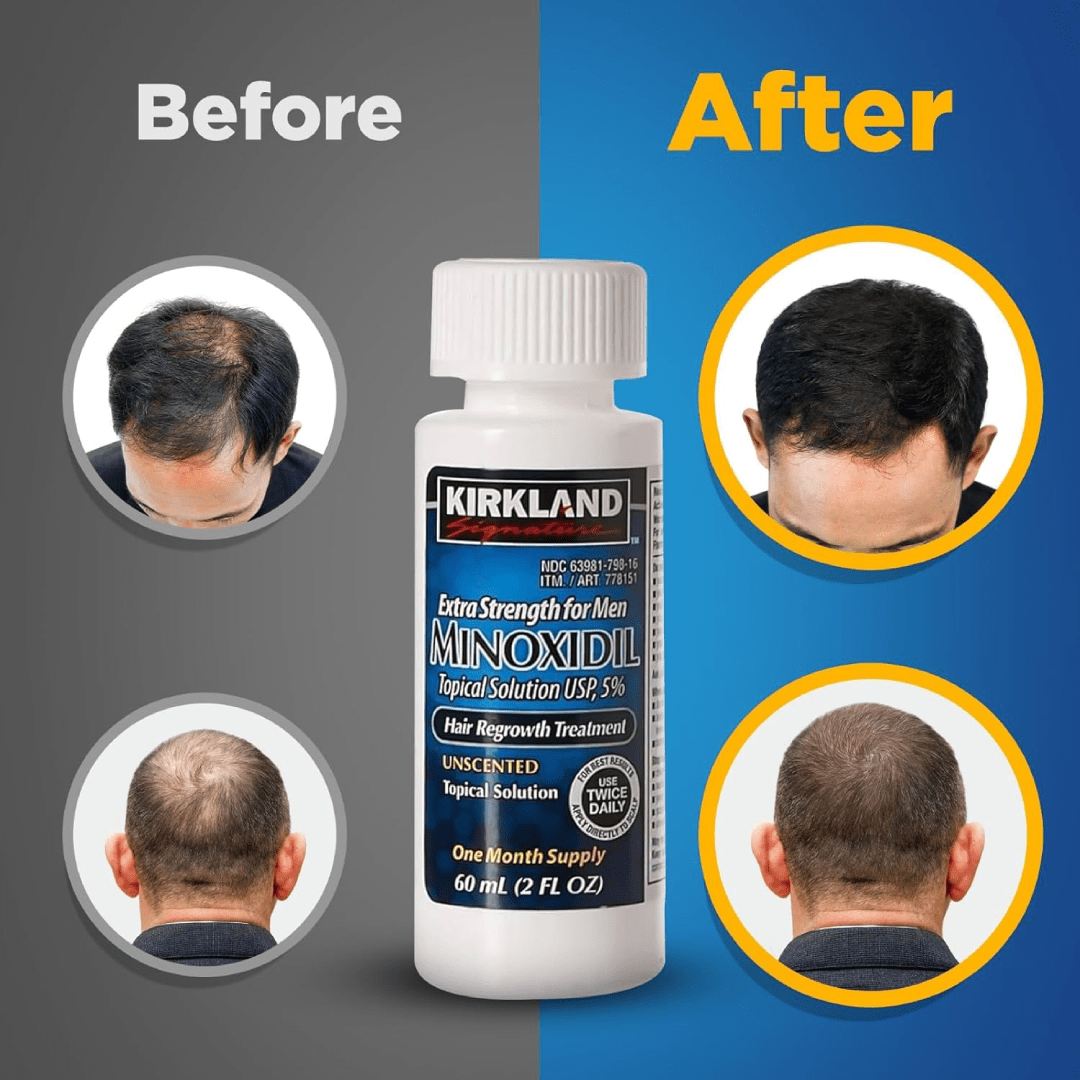 Kirkland Minoxidil 5% Hair Regrowth Solution (1 Month Supply)