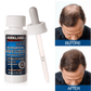 Kirkland Minoxidil 5% Hair Regrowth Solution (1 Month Supply)