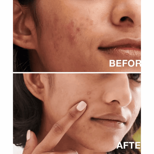 ( Discounted Product ) Neutrogena Oil-Free Acne Wash 269ml