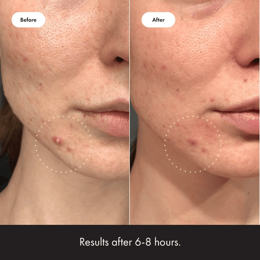 Hero Mighty Patch Invisible+ Hydrocolloid Acne Patches (24 Units)