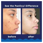 PanOxyl Acne Foaming Wash Benzoyl Peroxide 10% Maximum Strength Antimicrobial - Image 3