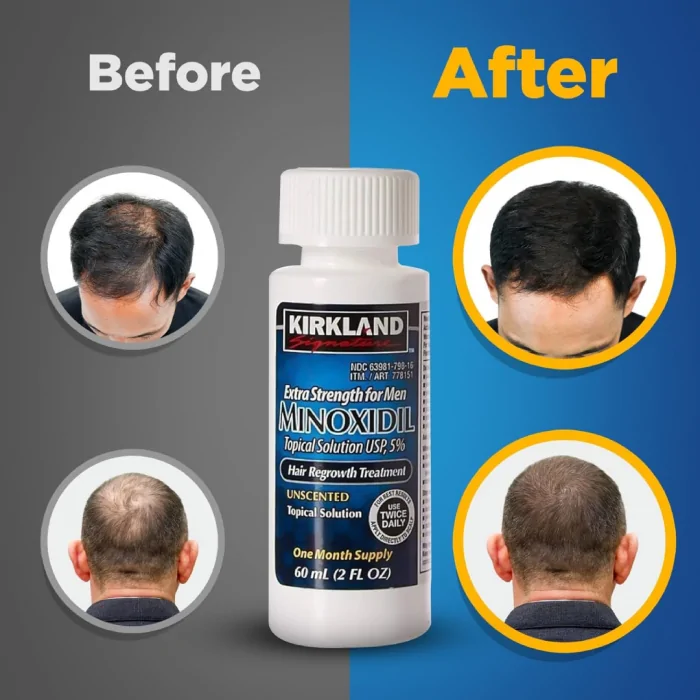 6 Months Kirkland Minoxidil 5% Extra Strength Hair Loss Regrowth Treatment Men - Image 5