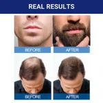 6 Months Kirkland Minoxidil 5% Extra Strength Hair Loss Regrowth Treatment Men - Image 7