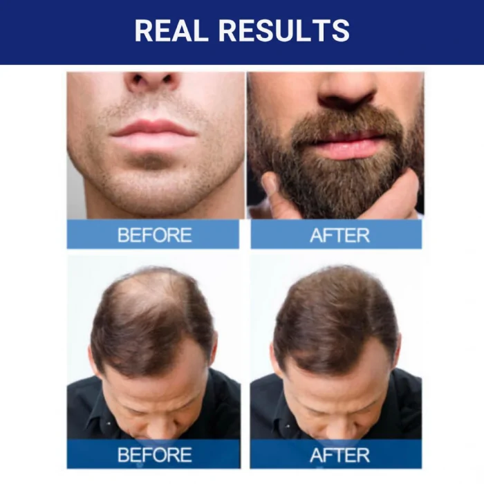 6 Months Kirkland Minoxidil 5% Extra Strength Hair Loss Regrowth Treatment Men - Image 7