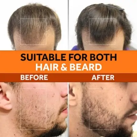 Kirkland Signature Minoxidil 5% Extra Strength Hair Regrowth Topical Solution - 1 Month Supply (1 x 2 oz Bottle) - Image 8