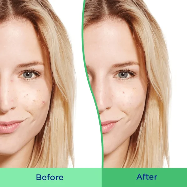(Discounted Product ) Differin Acne Face Wash with 5% Benzoyl Peroxide - Image 2