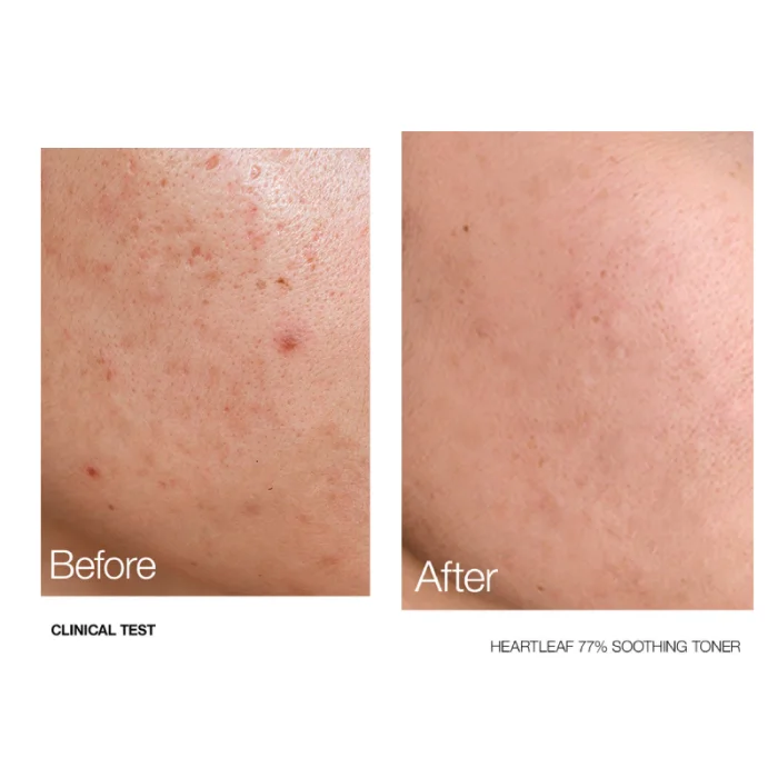 Anua Heartleaf 77% Soothing Toner - Image 2